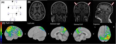 Presenilin-1 Mutations Are a Cause of Primary Lateral Sclerosis-Like Syndrome